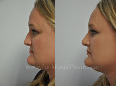 Rhinoplasty for nasal hump Houston TX