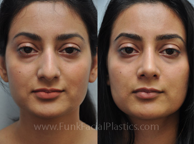 Top Nose Surgeon in Texas