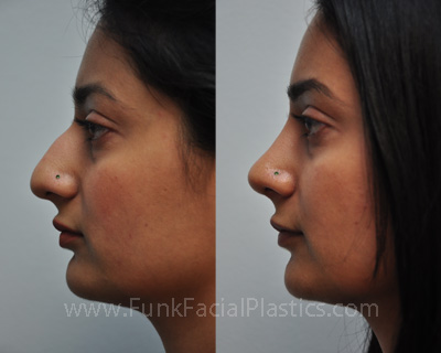 Nose Job Houston