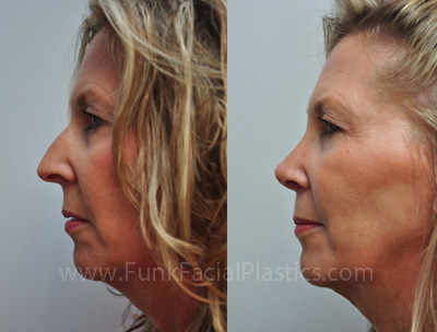 Best rhinoplasty surgeon in Houston