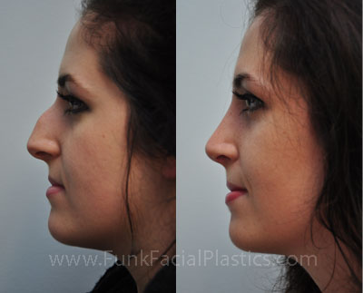 Best Nose Job Surgeon in Houston