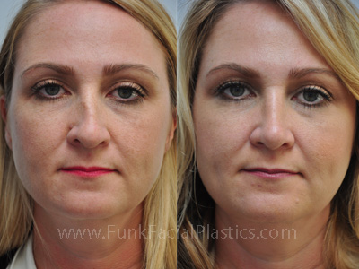 Crooked Nose Surgery Houston