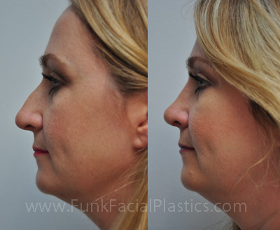 Deviated Septum Surgery Houston