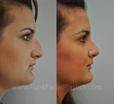 Rhinoplasty for hump 