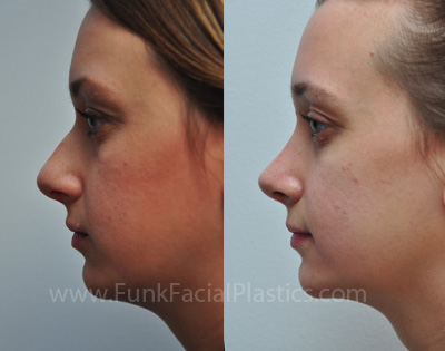 Nose Job Houston