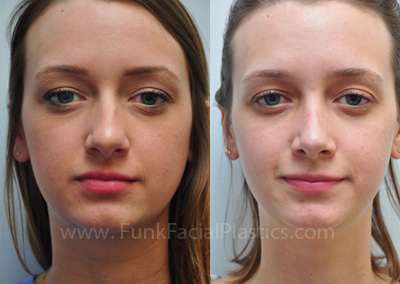 Rhinoplasty for a Crooked Nose