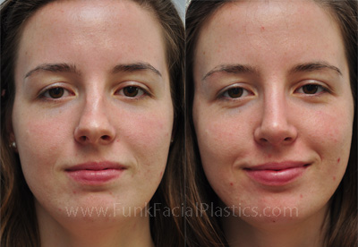 Top nose job surgeon Houston