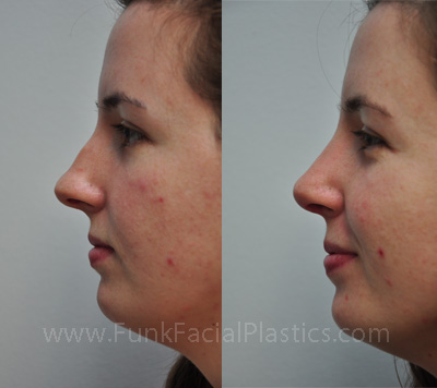 Top Rhinoplasty Surgeon Houston