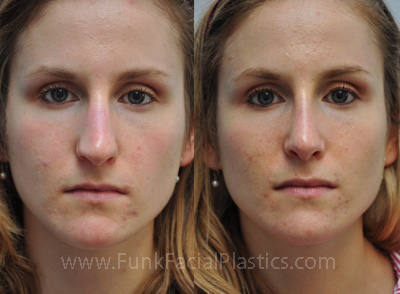 Rhinoplasty in Houston