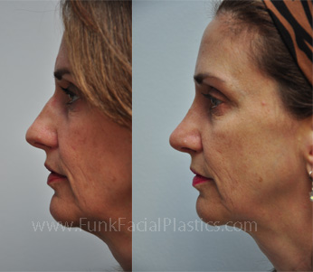 Nose Surgery Houston