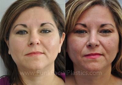 Nose surgery in Houston