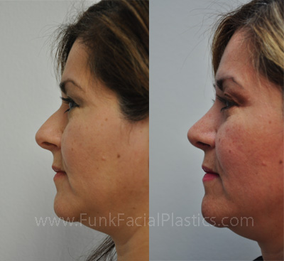 Nose job Houston