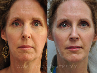 Nose Surgery Houston