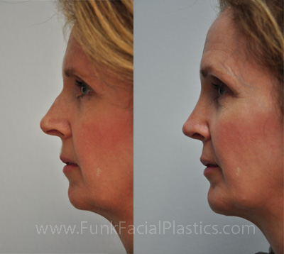 Rhinoplasty surgeon Houston