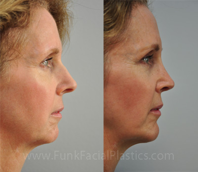 Nose job surgeon Houston