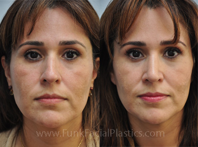 Top Nose Surgeon Houston