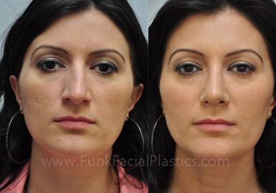 Rhinoplasty before and after Houston