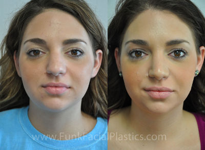 Rhinoplasty Houston