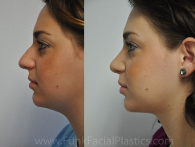 Rhinoplasty in Houston, TX