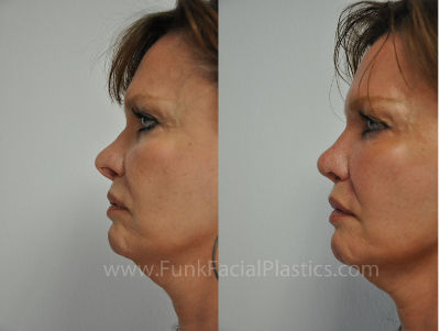 revision nose surgery for woman