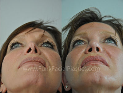 revision nose surgery houston tx