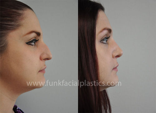 nose surgery houston tx