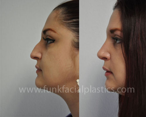 rhinoplasty surgeon houston