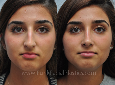 Nose Surgery Houston