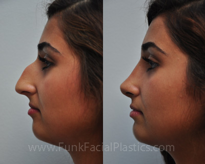 Nose Job Houston