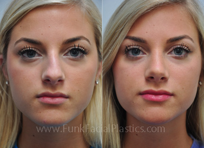 Rhinoplasty for Crooked Nose Houston