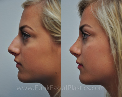 Nose Job for Teens Houston