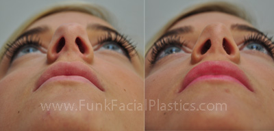 Rhinoplasty for bulbous tip