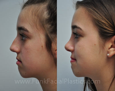 Best rhinoplasty surgeon Houston