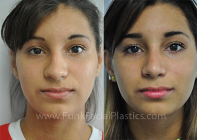 Nose Surgery Houston