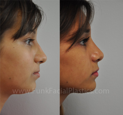 Nose Job Houston