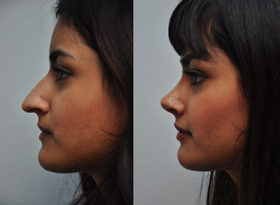 Best doctor for rhinoplasty in Houston