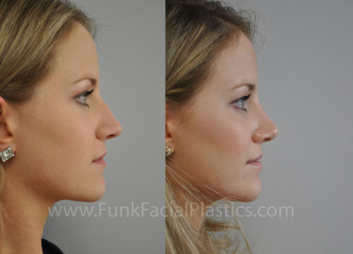 nose job surgeon houston