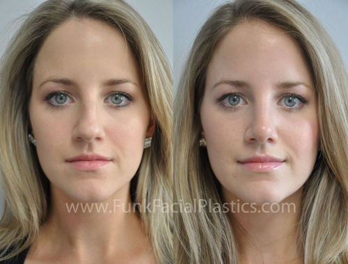 rhinoplasty surgeon houston, tx