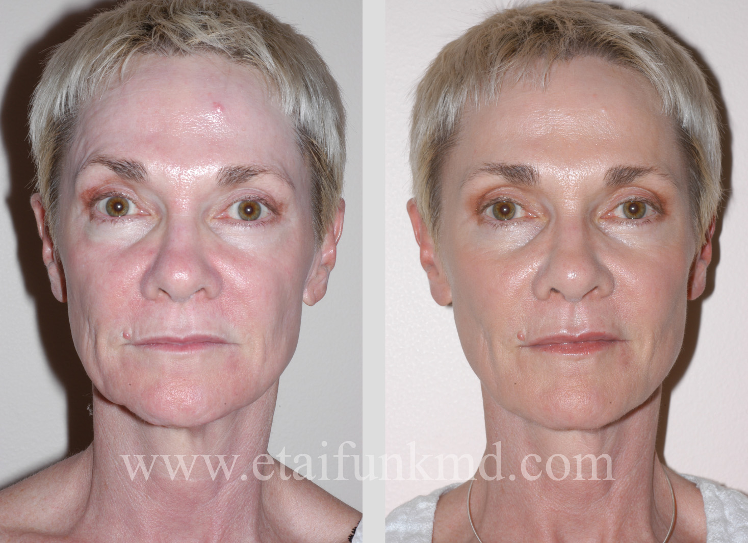 Radiesse to cheeks and jawline, Botox to improve right eyebrow