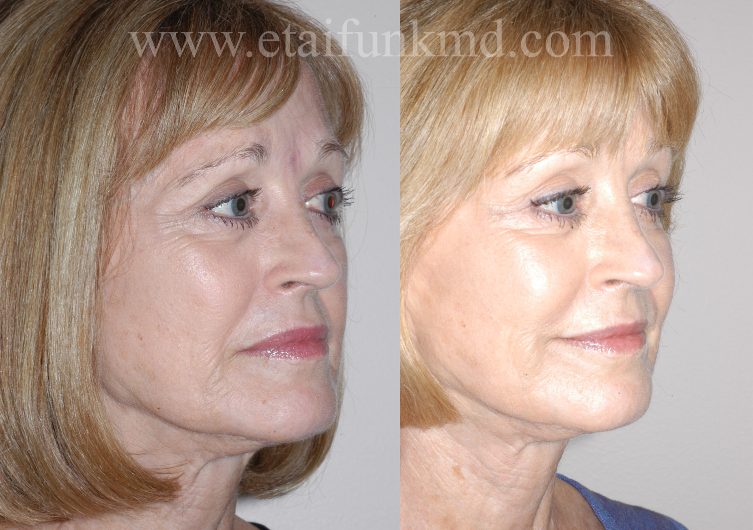 Radiesse to cheeks and jawline, restylane to folds and corners of mouth, Latisse, Botox to crow's feet and right brow.