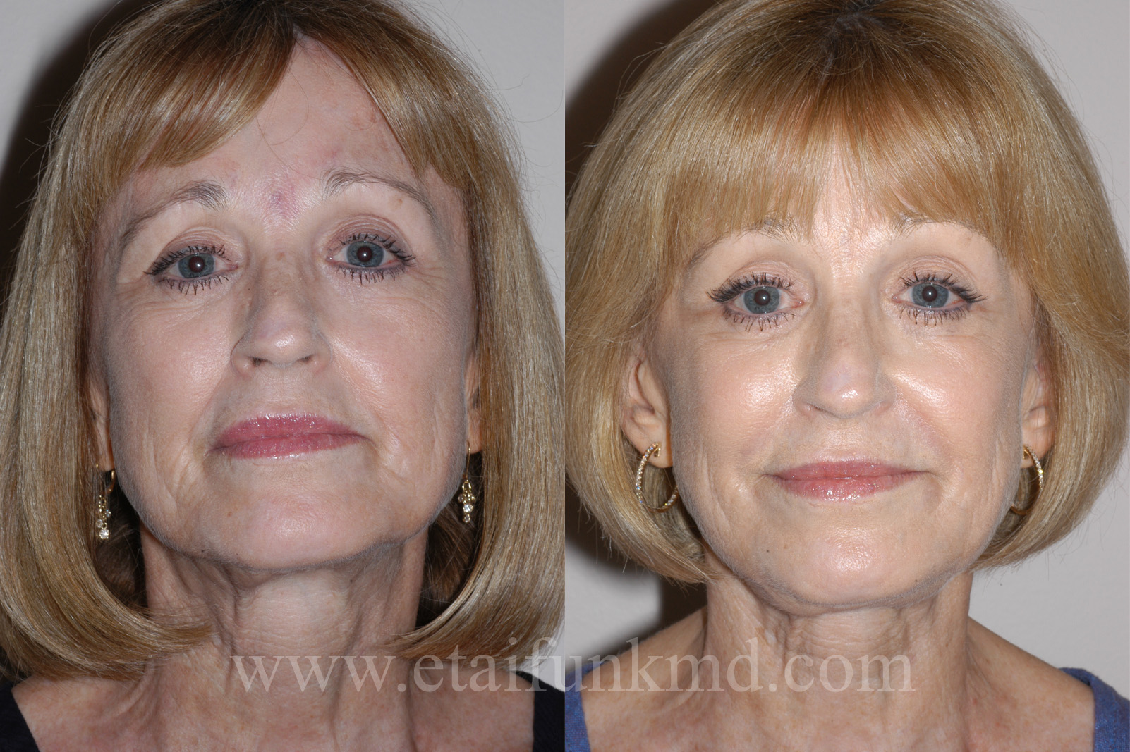 Radiesse to cheeks and jawline, Restylane to folds and corners of mouth, Latisse