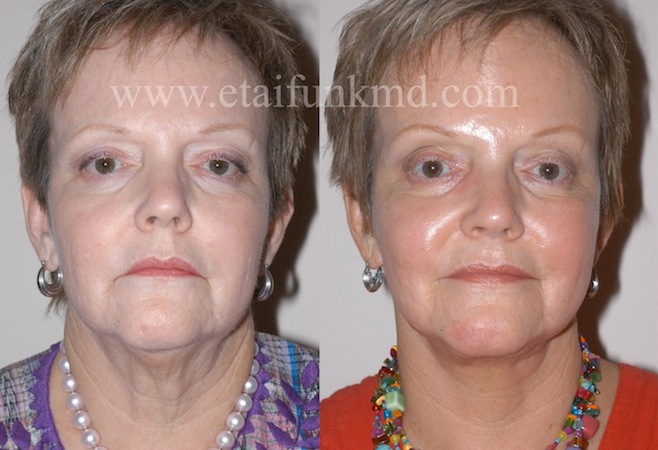 Houston Facelift Surgery