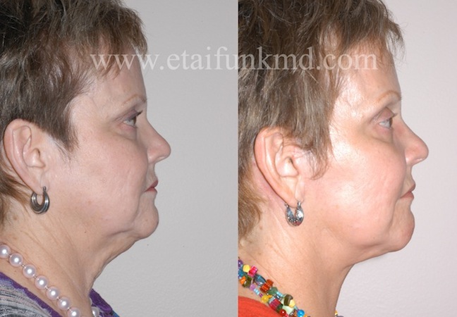 Facelift Surgeon Houston