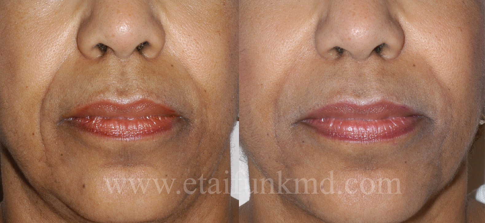 Filler to enhance cheek/lip fold