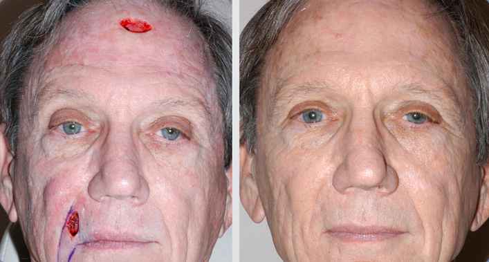 Facial Reconstruction after Mohs surgery for Skin Cancer