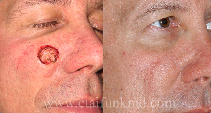 Facial Reconstruction after Mohs surgery for Skin Cancer