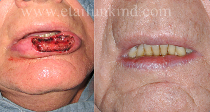 Facial Reconstruction after Mohs surgery for Skin Cancer