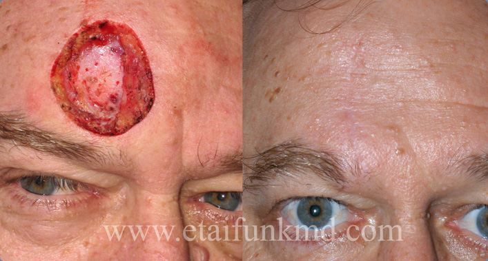 Facial Reconstruction after Mohs surgery for Skin Cancer