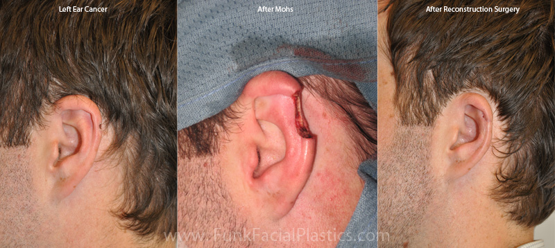 Ear reconstruction Houston