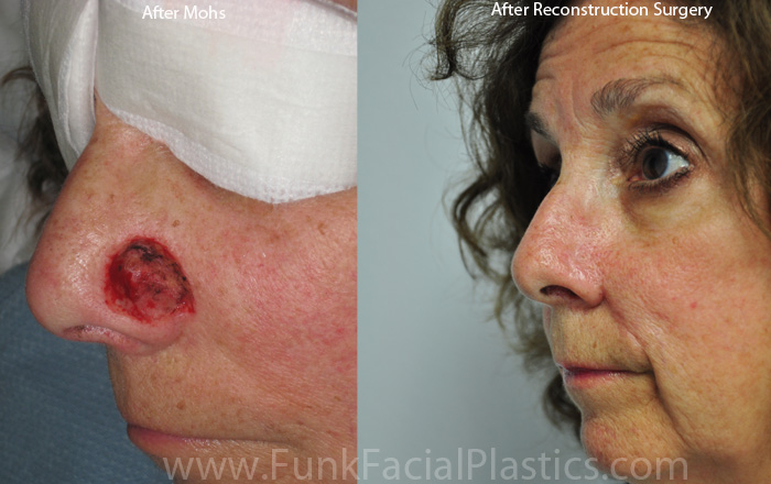 Nasal Reconstruction Houston